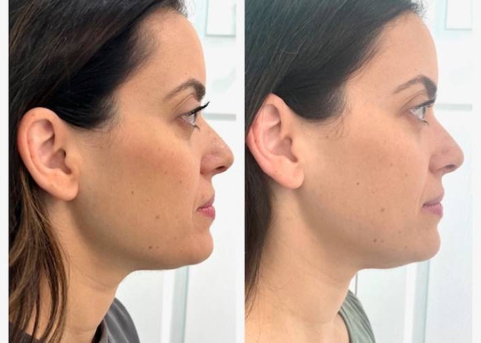 Aqualyx jawline before and after, three sessions